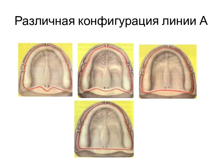 Различная конфигурация линии А