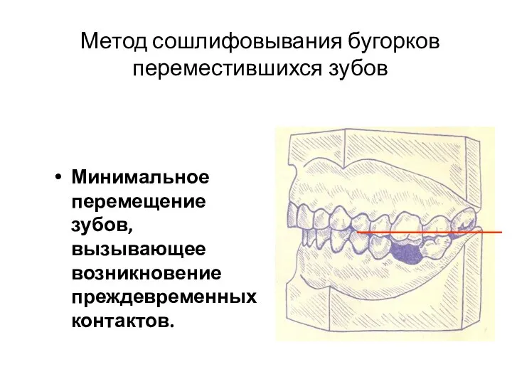 Метод сошлифовывания бугорков переместившихся зубов Минимальное перемещение зубов, вызывающее возникновение преждевременных контактов.