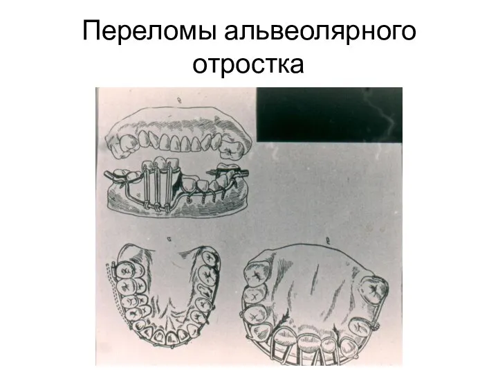 Переломы альвеолярного отростка