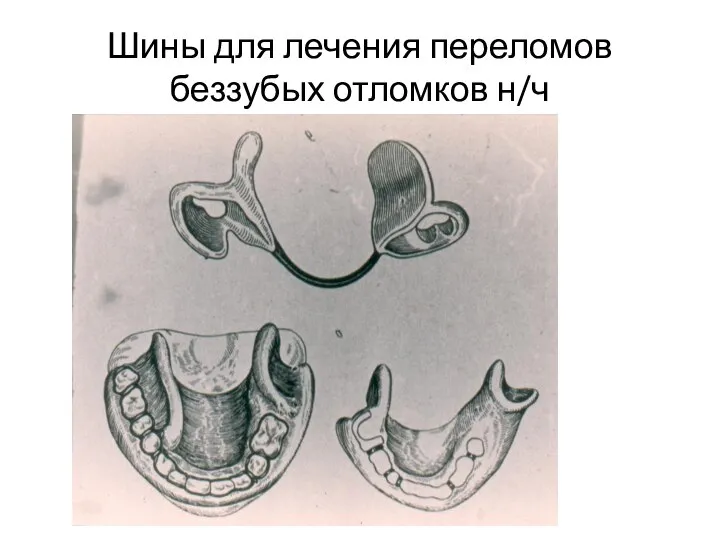 Шины для лечения переломов беззубых отломков н/ч