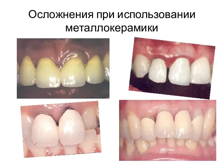 Осложнения при использовании металлокерамики