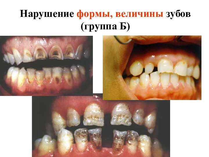 Нарушение формы, величины зубов (группа Б)