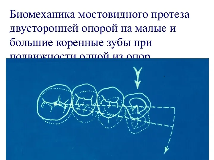 Биомеханика мостовидного протеза двусторонней опорой на малые и большие коренные зубы при подвижности одной из опор.