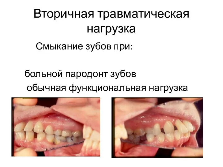 Вторичная травматическая нагрузка Смыкание зубов при: больной пародонт зубов обычная функциональная нагрузка