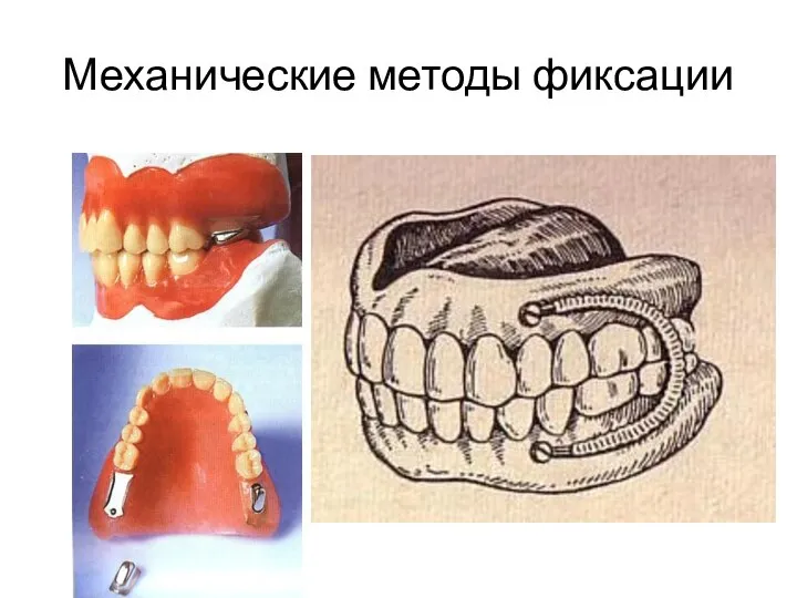 Механические методы фиксации