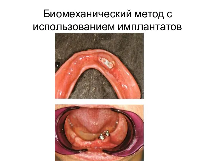 Биомеханический метод с использованием имплантатов