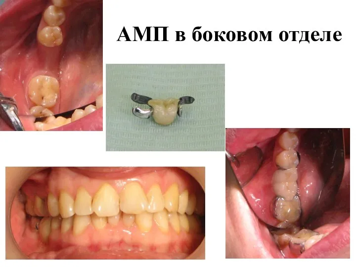 АМП в боковом отделе