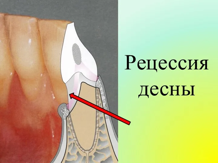 Рецессия десны