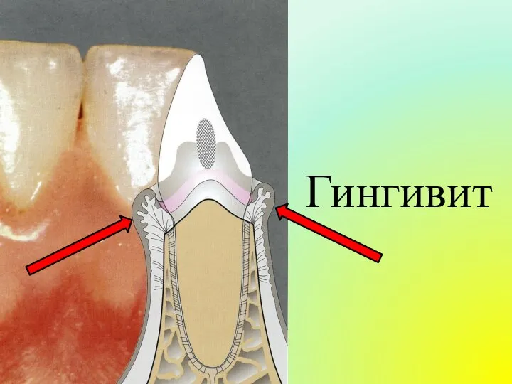 Гингивит