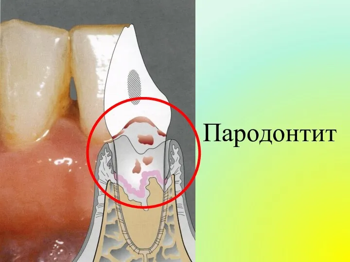 Пародонтит