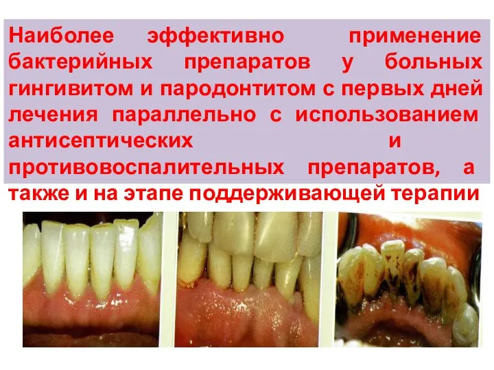 Наиболее эффективно применение бактерийных препаратов у больных гингивитом и пародонтитом с