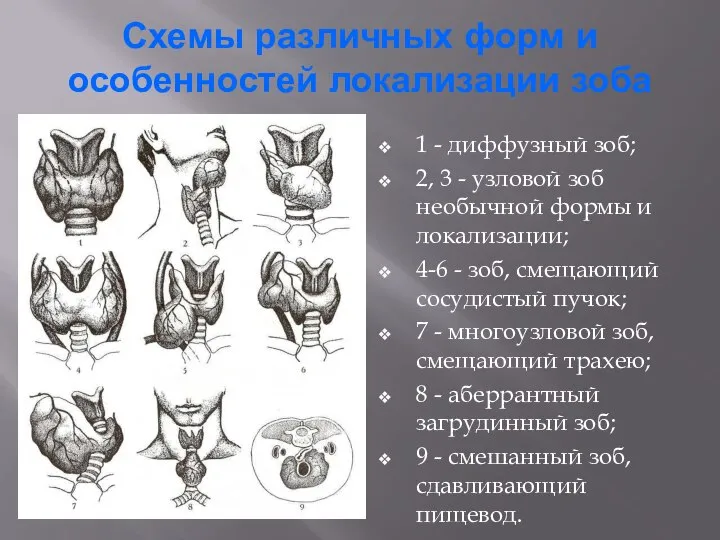 Схемы различных форм и особенностей локализации зоба 1 - диффузный зоб;