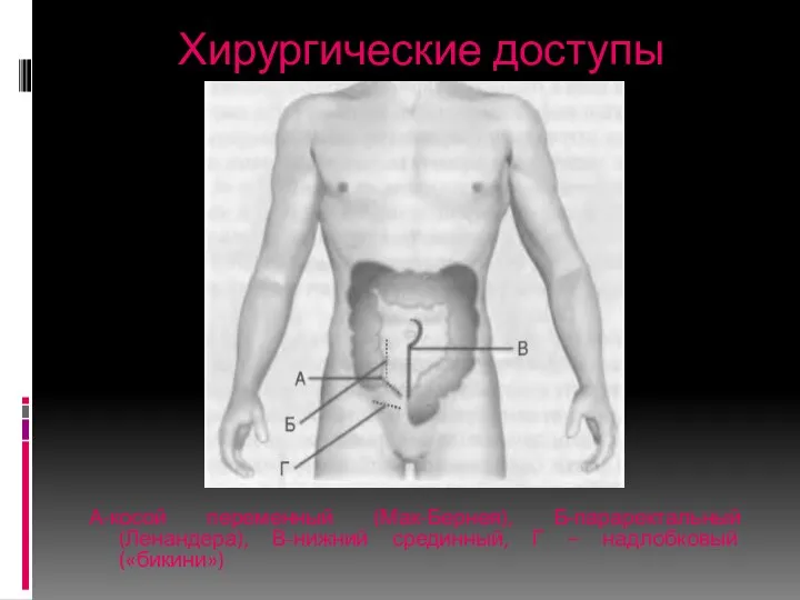 Хирургические доступы А-косой переменный (Мак-Бернея), Б-параректальный (Ленандера), В-нижний срединный, Г – надлобковый («бикини»)