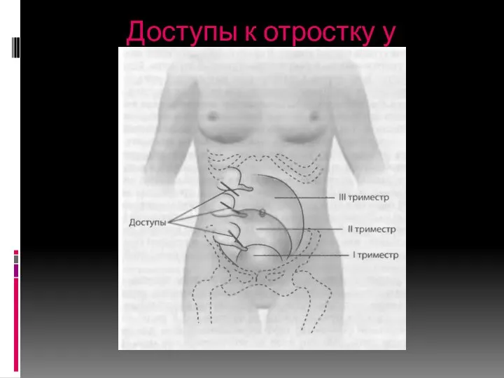 Доступы к отростку у беременных