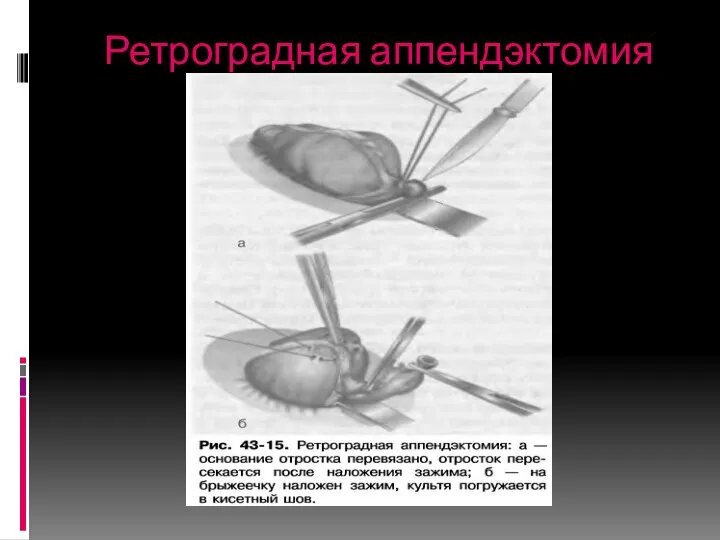 Ретроградная аппендэктомия