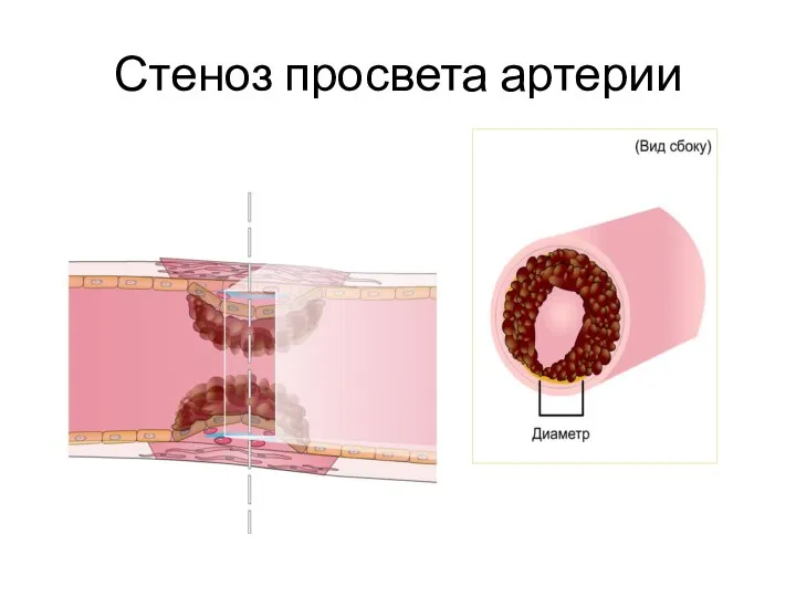 Стеноз просвета артерии