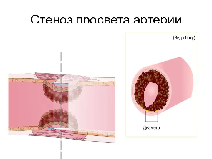 Стеноз просвета артерии