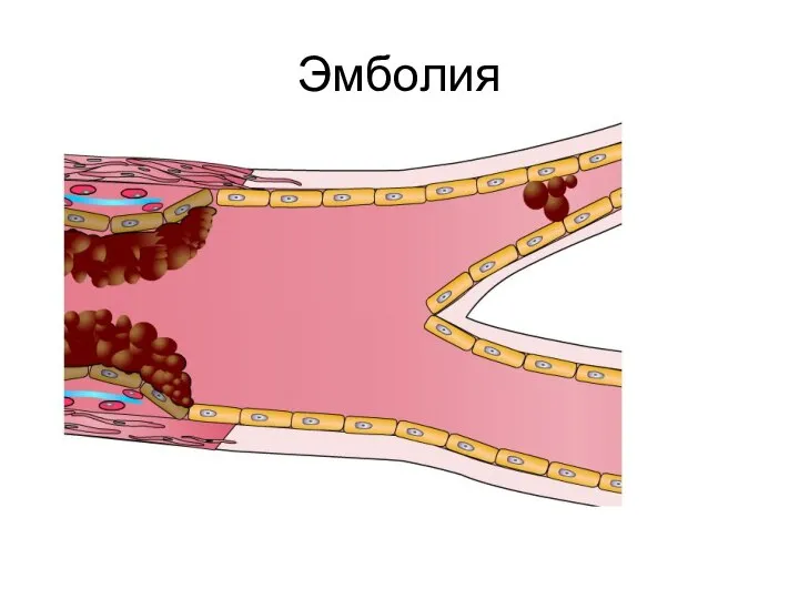 Эмболия