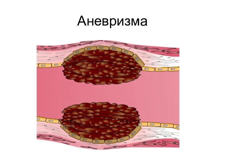 Аневризма