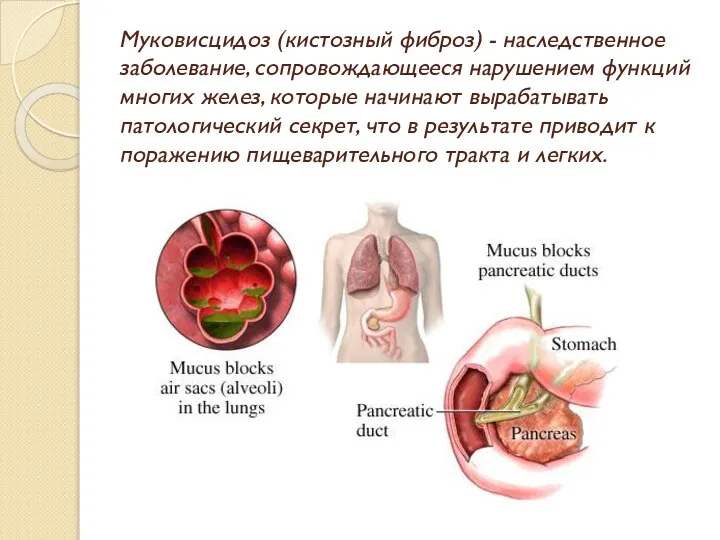 Муковисцидоз (кистозный фиброз) - наследственное заболевание, сопровождающееся нарушением функций многих желез,
