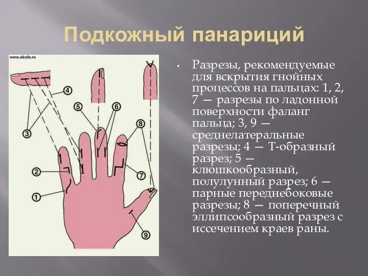 Подкожный панариций Разрезы, рекомендуемые для вскрытия гнойных процессов на пальцах: 1,