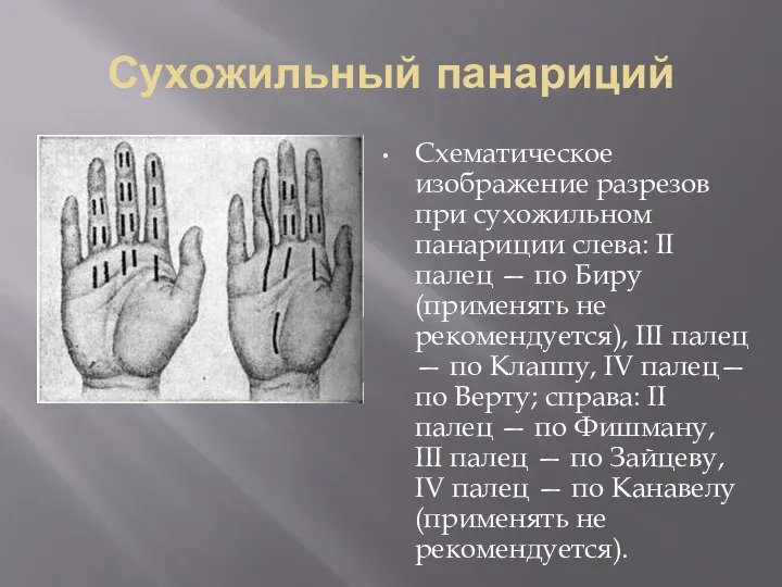 Сухожильный панариций Схематическое изображение разрезов при сухожильном панариции слева: II палец