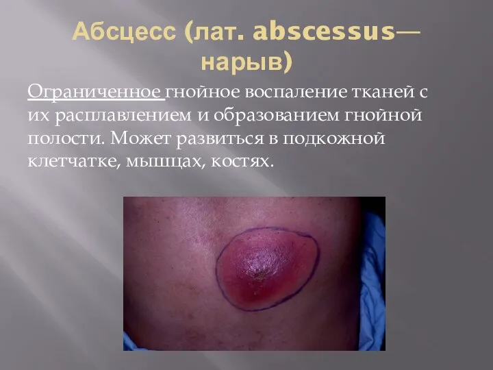Абсцесс (лат. abscessus—нарыв) Ограниченное гнойное воспаление тканей с их расплавлением и