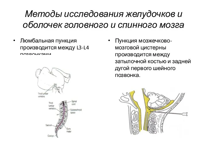 Методы исследования желудочков и оболочек головного и спинного мозга Люмбальная пункция