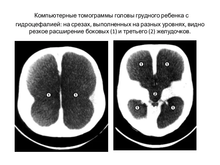 Компьютерные томограммы головы грудного ребенка с гидроцефалией: на срезах, выполненных на