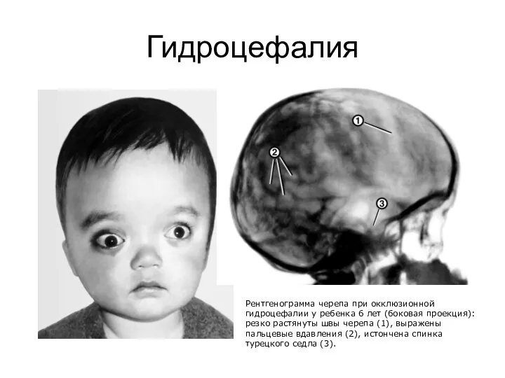 Гидроцефалия Рентгенограмма черепа при окклюзионной гидроцефалии у ребенка 6 лет (боковая