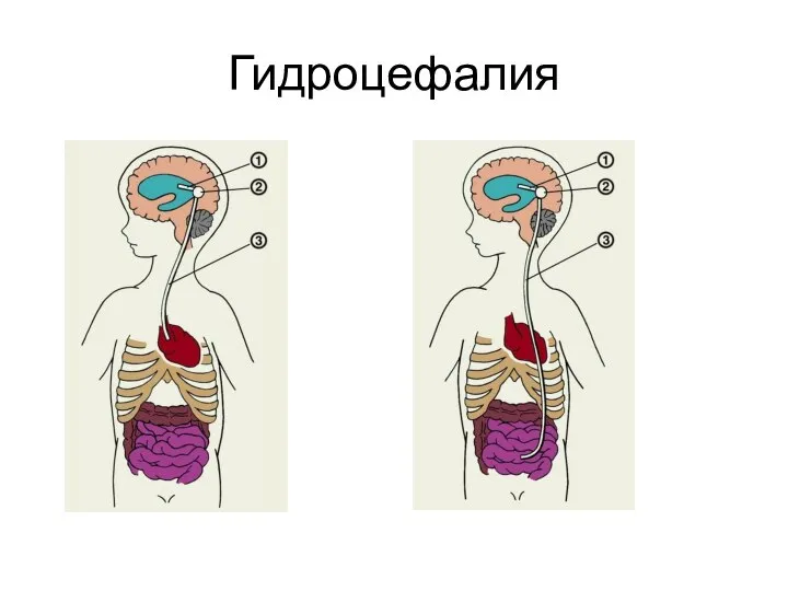 Гидроцефалия