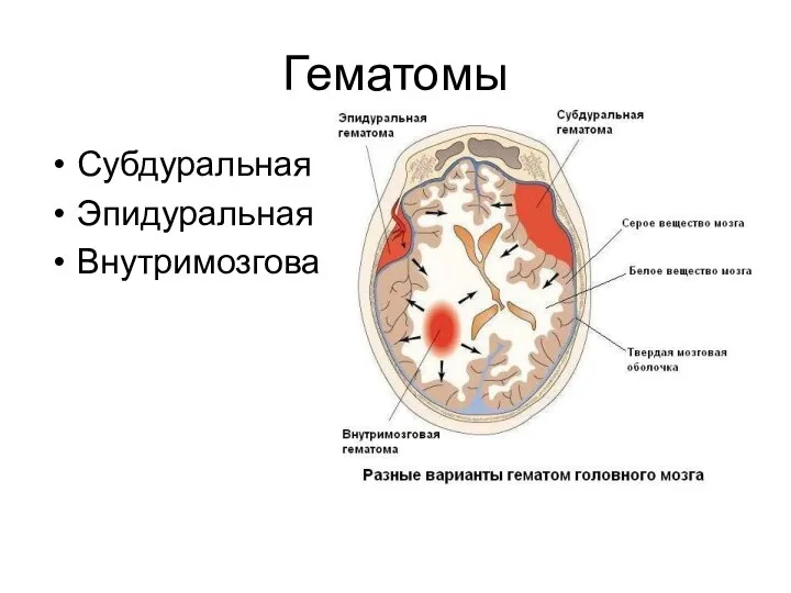 Гематомы Субдуральная Эпидуральная Внутримозговая