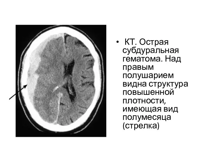 КТ. Острая субдуральная гематома. Над правым полушарием видна структура повышенной плотности, имеющая вид полумесяца (стрелка)