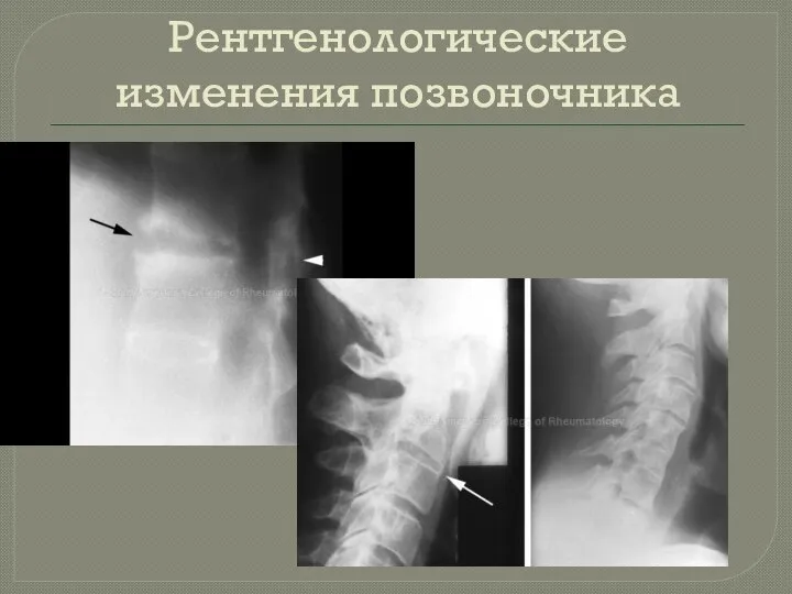 Рентгенологические изменения позвоночника