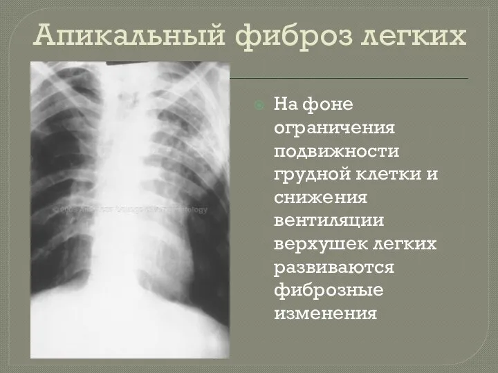 Апикальный фиброз легких На фоне ограничения подвижности грудной клетки и снижения