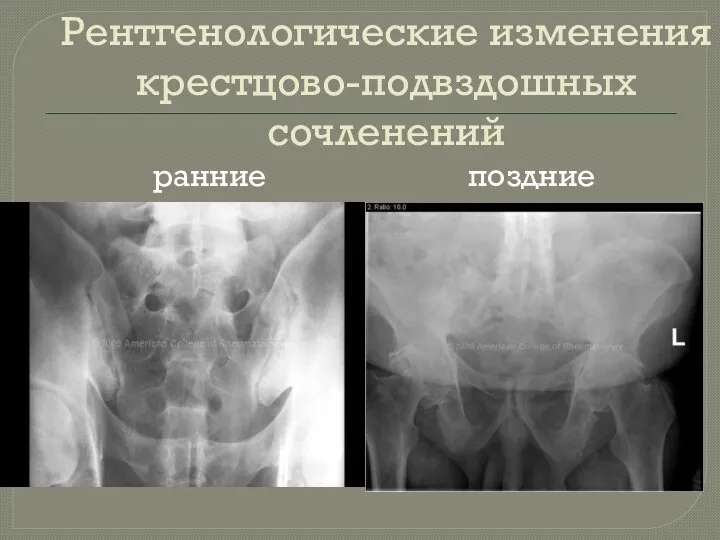 Рентгенологические изменения крестцово-подвздошных сочленений ранние поздние