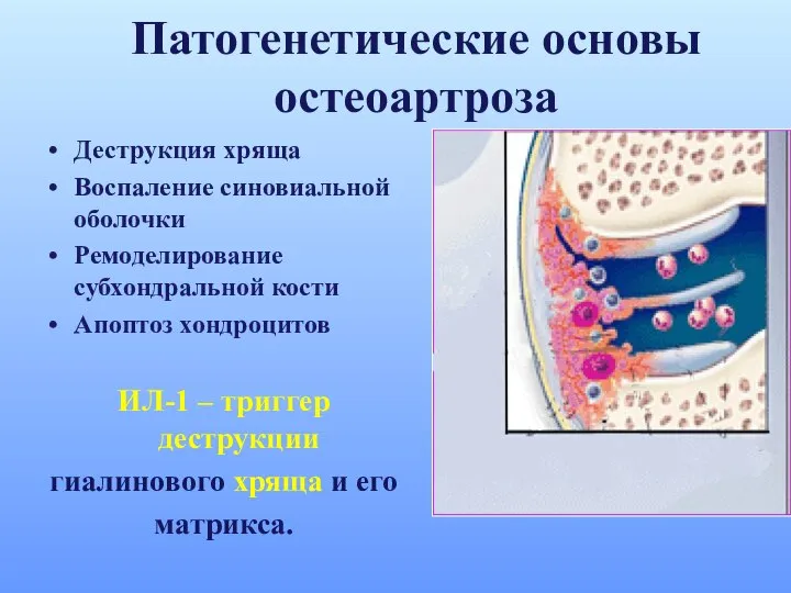 Патогенетические основы остеоартроза Деструкция хряща Воспаление синовиальной оболочки Ремоделирование субхондральной кости