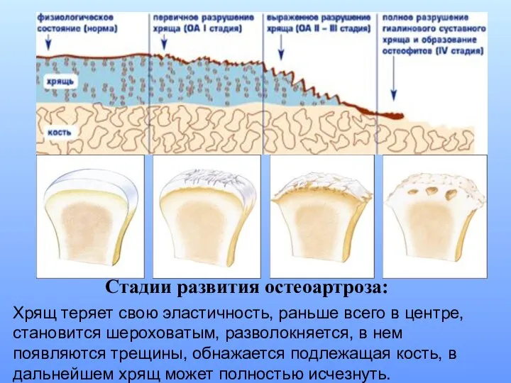 Стадии развития остеоартроза: Хрящ теряет свою эластичность, раньше всего в центре,