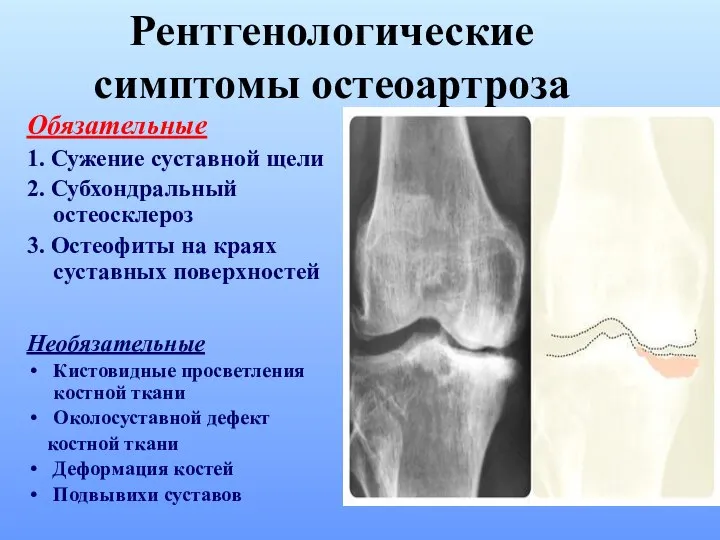 Обязательные 1. Сужение суставной щели 2. Субхондральный остеосклероз 3. Остеофиты на