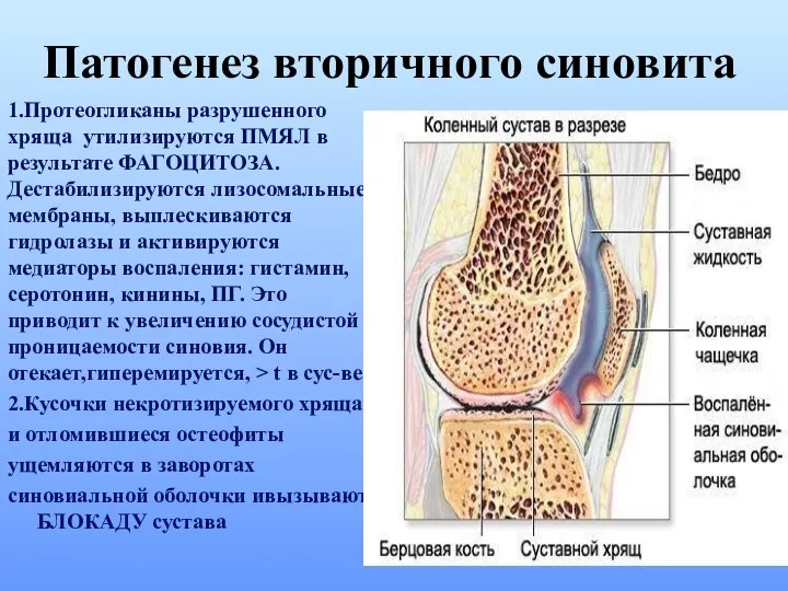 1.Протеогликаны разрушенного хряща утилизируются ПМЯЛ в результате ФАГОЦИТОЗА. Дестабилизируются лизосомальные мембраны,