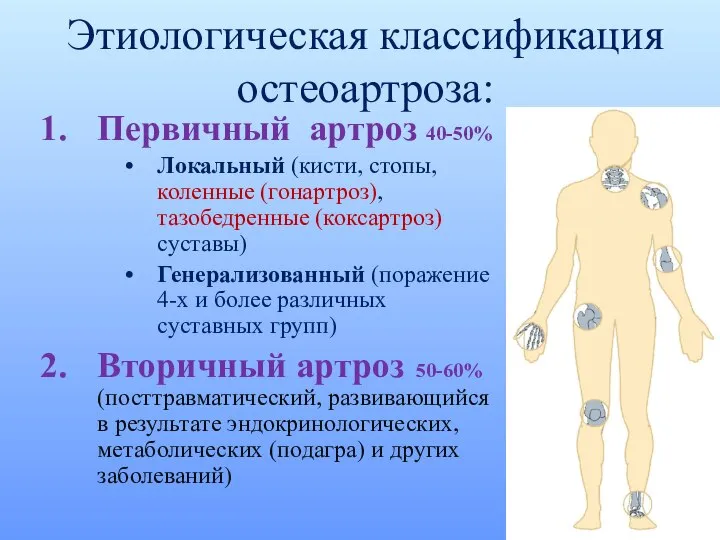 Этиологическая классификация остеоартроза: Первичный артроз 40-50% Локальный (кисти, стопы, коленные (гонартроз),