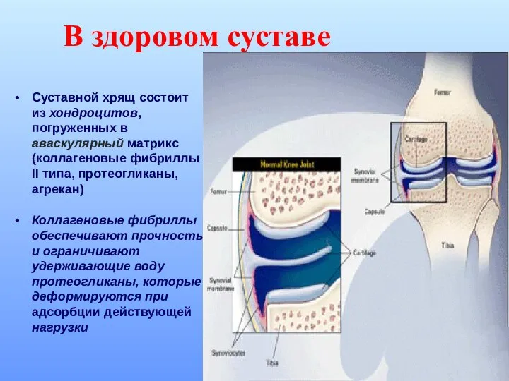 В здоровом суставе Суставной хрящ состоит из хондроцитов, погруженных в аваскулярный