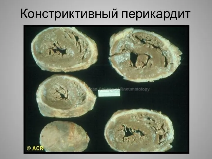 Констриктивный перикардит