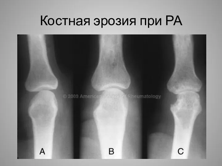 Костная эрозия при РА