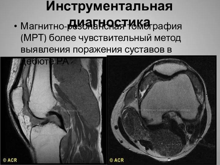 Инструментальная диагностика Магнитно-резонансная томография (МРТ) более чувствительный метод выявления поражения суставов в дебюте РА