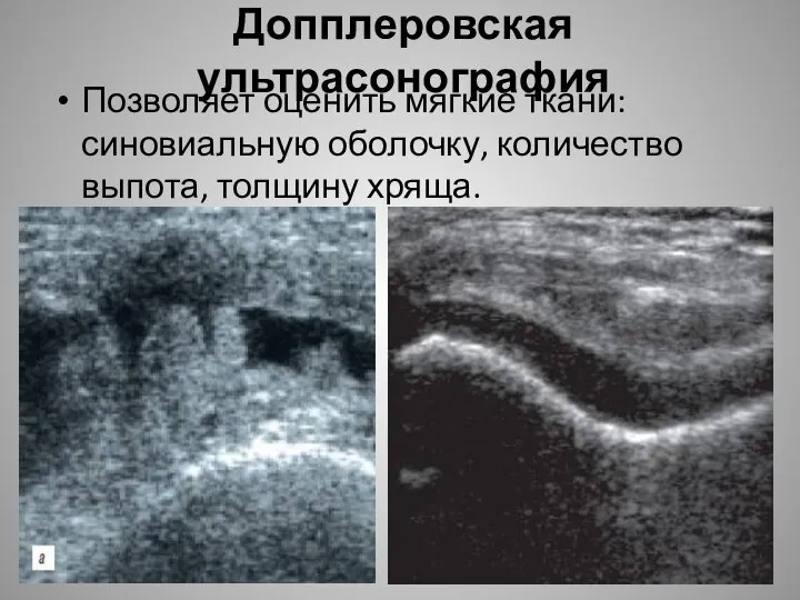 Допплеровская ультрасонография Позволяет оценить мягкие ткани: синовиальную оболочку, количество выпота, толщину хряща.