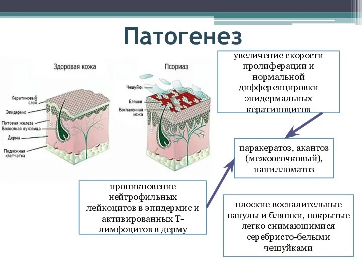 Патогенез увеличение скорости пролиферации и нормальной дифференцировки эпидермальных кератиноцитов проникновение нейтрофильных