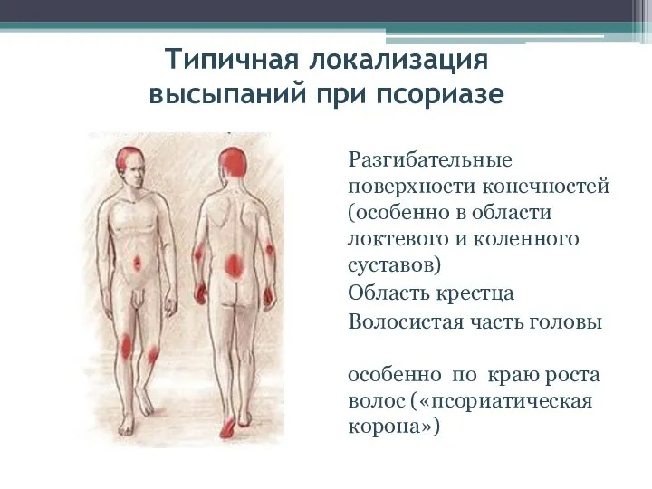 Типичная локализация высыпаний при псориазе Разгибательные поверхности конечностей (особенно в области