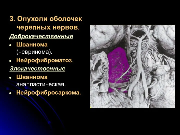 3. Опухоли оболочек черепных нервов. Доброкачественные Шваннома (невринома). Нейрофиброматоз. Злокачественные Шваннома анапластическая. Нейрофибросаркома.