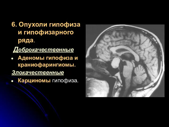 6. Опухоли гипофиза и гипофизарного ряда. Доброкачественные Аденомы гипофиза и краниофарингиомы. Злокачественные Карциномы гипофиза.